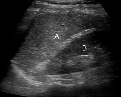Ultrasonido abdominal
