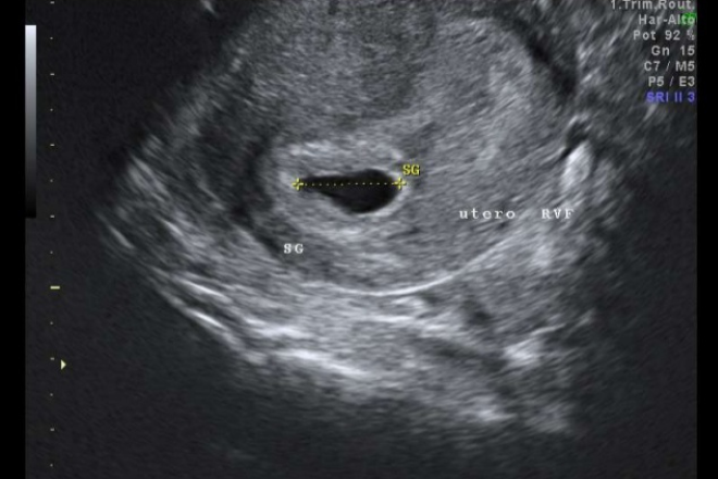 Ultrasonido obstétrico